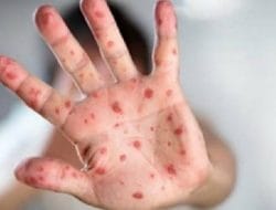 Tips Penanganan Saat Anak Alami Campak
