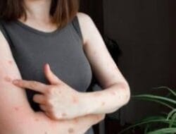 Cacar Monyet Merebak, Dinkes Makassar Imbau Warga Hindari Kontak Langsung