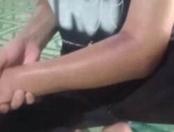 Dikeroyok Hingga Tangan Patah dan Wajah Lebam, Keluarga Desak Polres Takalar Tangkap Pelaku